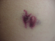 yo bruise